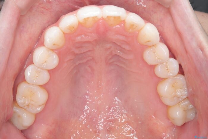 前歯のガタつきをインビザラインで治す 治療後画像