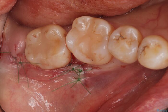 埋伏歯の抜歯 治療後画像