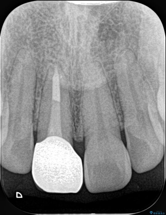 保険治療をした前歯の色が気になる 治療後画像