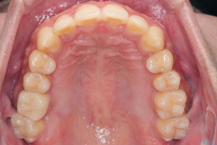 気になるガタつきをインビザラインですっきり 治療後画像