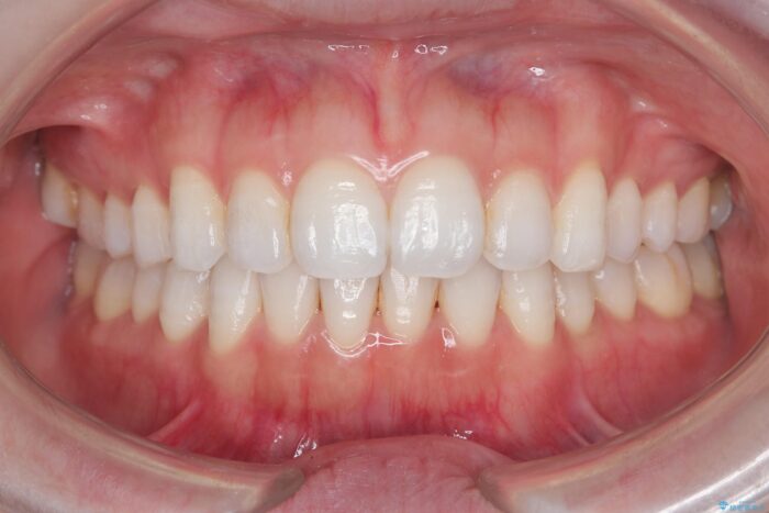 前歯のガタつきをインビザラインで治す 治療後画像