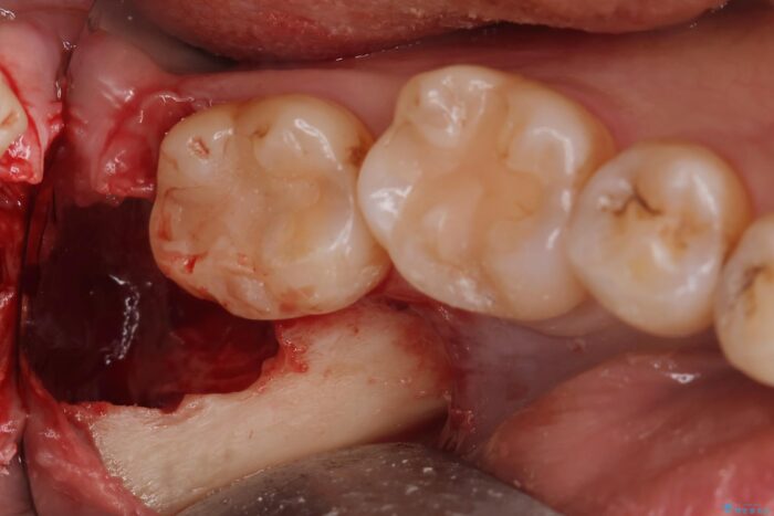埋伏歯の抜歯 治療後画像