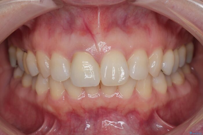 保険治療をした前歯の色が気になる 治療後画像