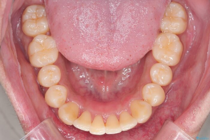 気になるガタつきをインビザラインですっきり 治療後画像