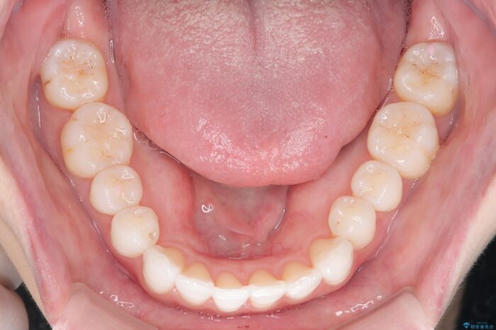 前歯のガタつきをインビザラインで治す 治療後画像