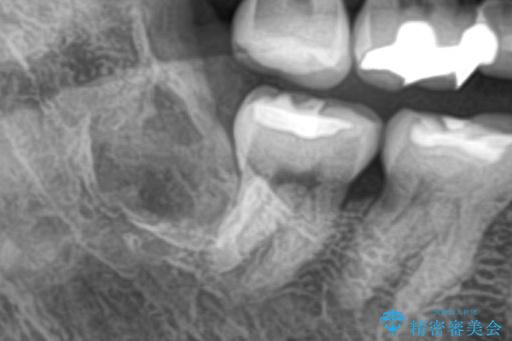 埋伏歯の抜歯 治療後画像