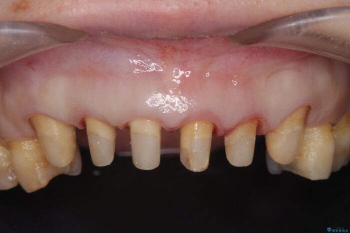 前歯のセラミックと歯周外科治療 治療途中画像