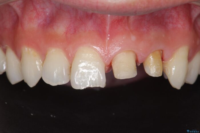 前歯のセラミック治療 治療途中画像
