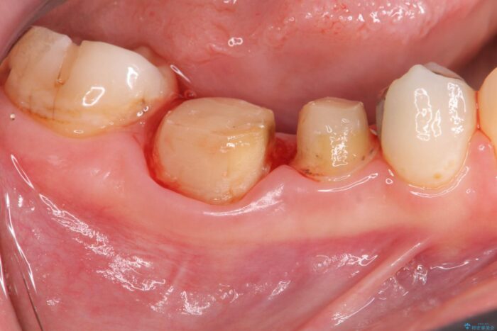 銀歯の下の虫歯治療と歯周外科治療 治療途中画像