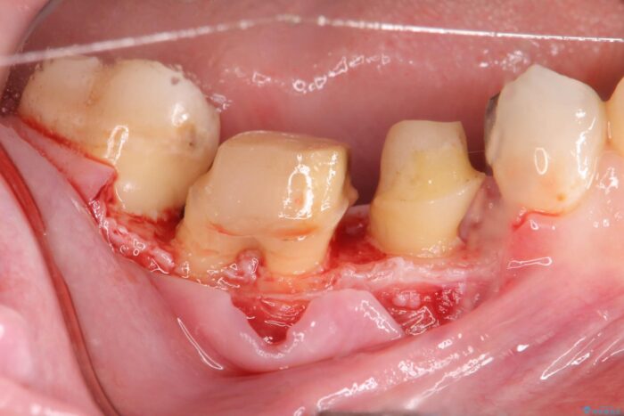 銀歯の下の虫歯治療と歯周外科治療 治療途中画像