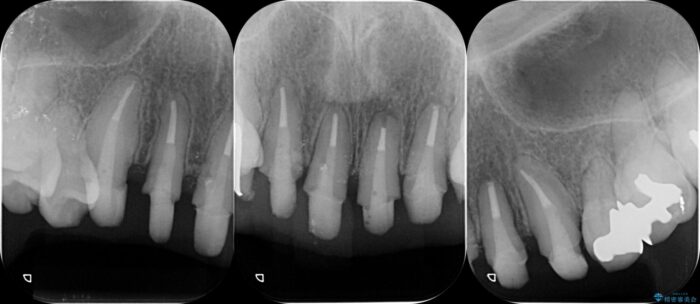 前歯のセラミックと歯周外科治療 治療途中画像