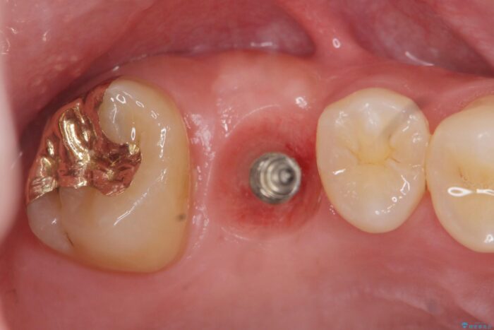 骨が足りない上あごへの骨造成を伴うインプラント治療 治療途中画像