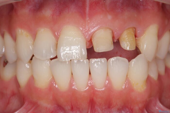 前歯のセラミック治療 治療途中画像