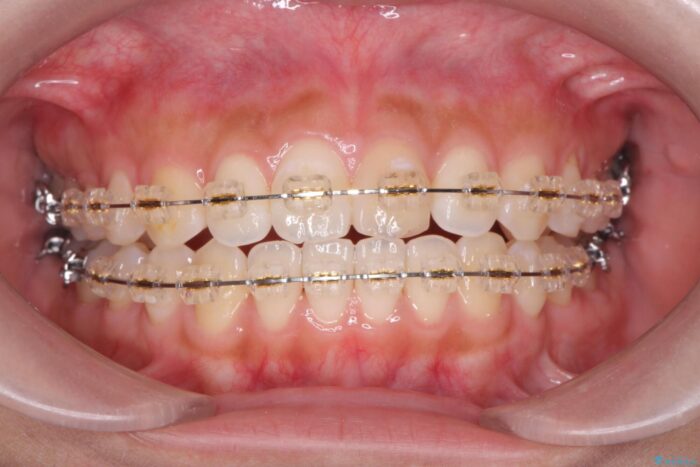 すきっ歯をワイヤー矯正で改善 治療途中画像