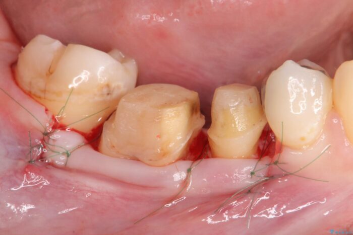 銀歯の下の虫歯治療と歯周外科治療 治療途中画像