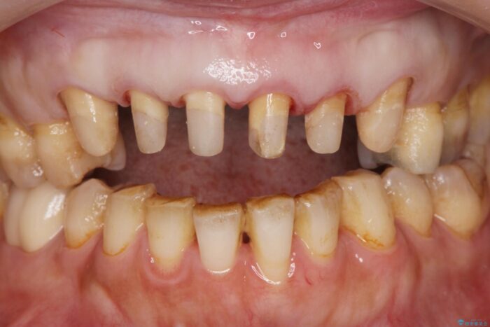 前歯のセラミックと歯周外科治療 治療途中画像