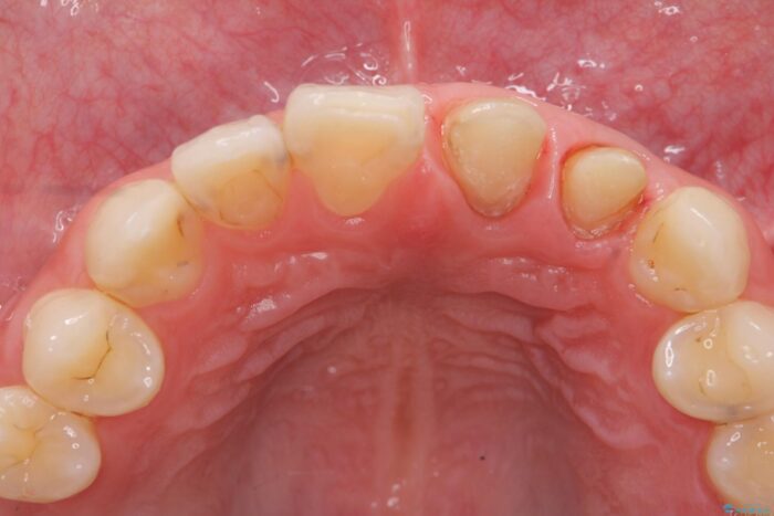 前歯のセラミック治療 治療途中画像