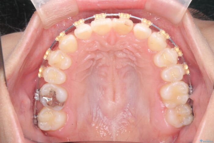 すきっ歯をワイヤー矯正で改善 治療途中画像