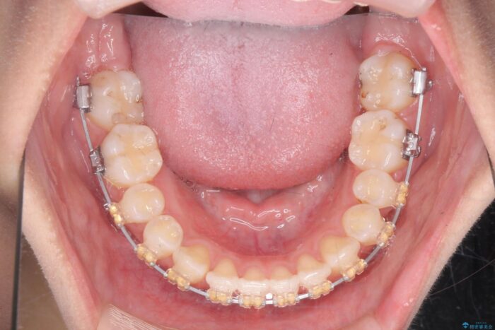 すきっ歯をワイヤー矯正で改善 治療途中画像