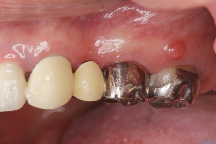 セラミックブリッジで銀歯を白く ビフォー