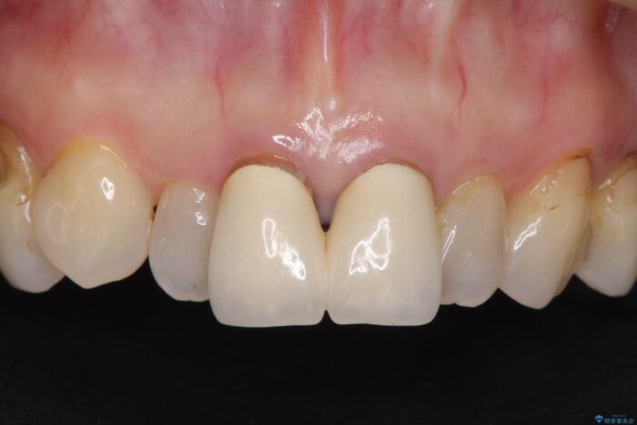 黒ずみのある前歯をセラミックで美しく ビフォー