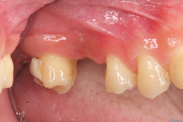 骨が足りない上あごへの骨造成を伴うインプラント治療 ビフォー
