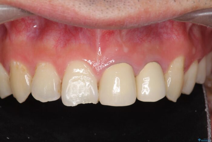 前歯のセラミック治療 ビフォー