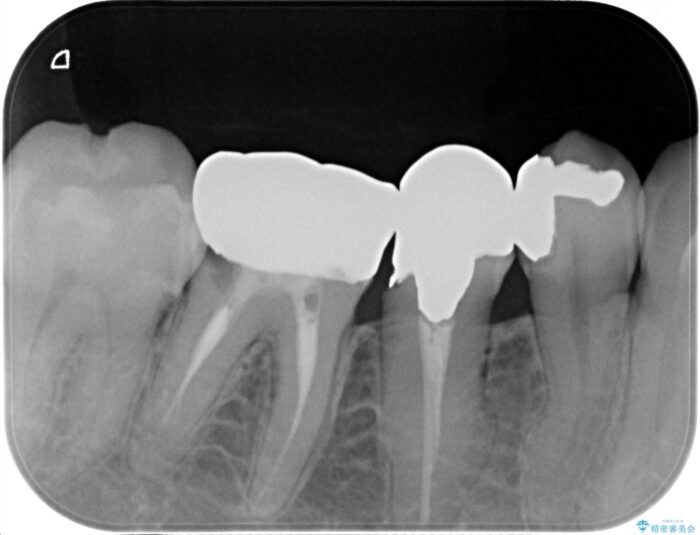 銀歯の下の虫歯治療と歯周外科治療 ビフォー