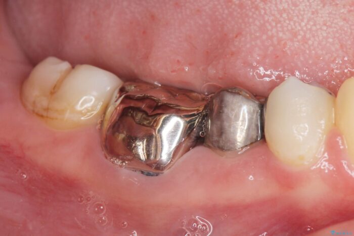 銀歯の下の虫歯治療と歯周外科治療 治療前画像