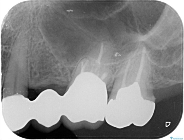 セラミックブリッジで銀歯を白く 治療前画像