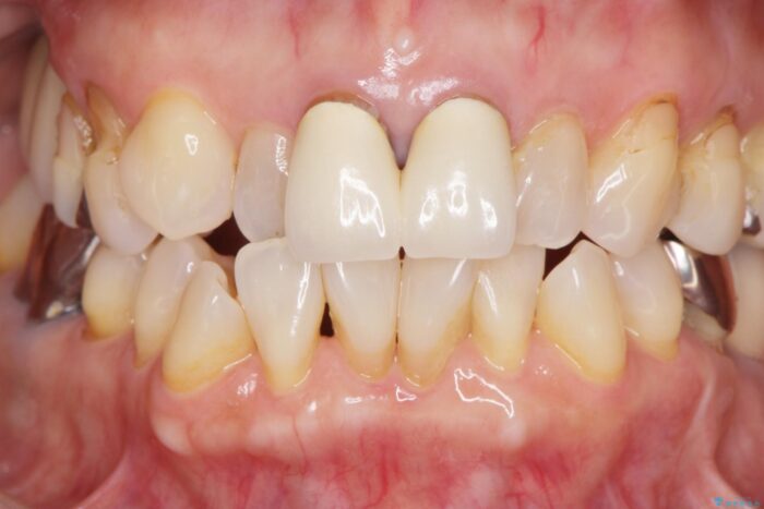 黒ずみのある前歯をセラミックで美しく 治療前画像