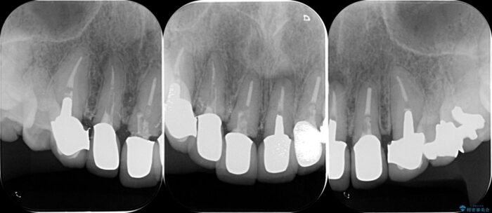 前歯のセラミックと歯周外科治療 治療前画像