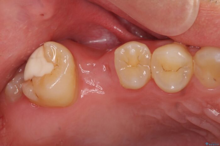 骨が足りない上あごへの骨造成を伴うインプラント治療 治療前画像
