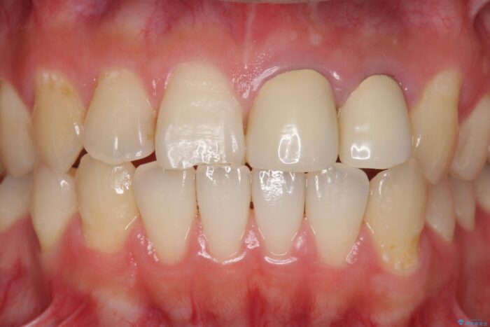 前歯のセラミック治療 治療前画像