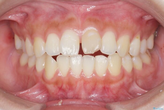 すきっ歯をワイヤー矯正で改善 ビフォー