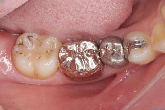 銀歯の下の虫歯治療と歯周外科治療 治療前画像
