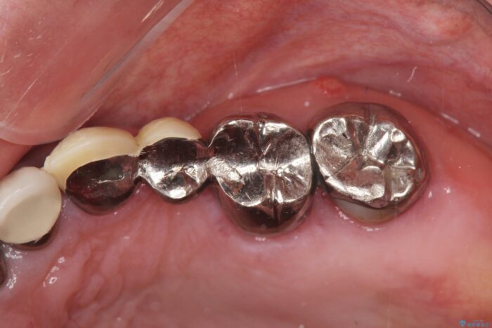 セラミックブリッジで銀歯を白く 治療前画像
