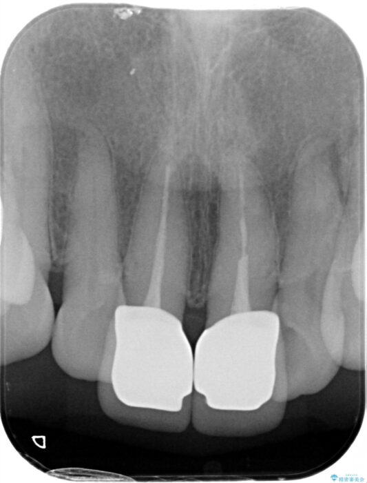 黒ずみのある前歯をセラミックで美しく 治療前画像