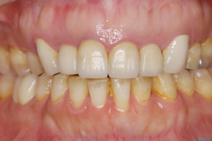 前歯のセラミックと歯周外科治療 治療前画像