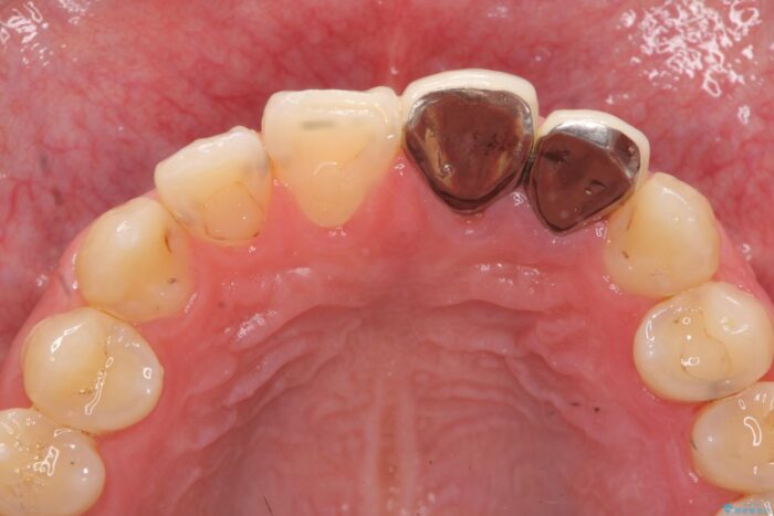 前歯のセラミック治療 治療前画像