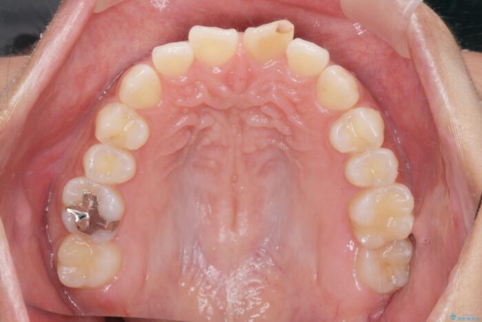 すきっ歯をワイヤー矯正で改善 治療前画像