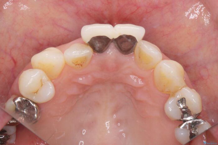 黒ずみのある前歯をセラミックで美しく 治療前画像