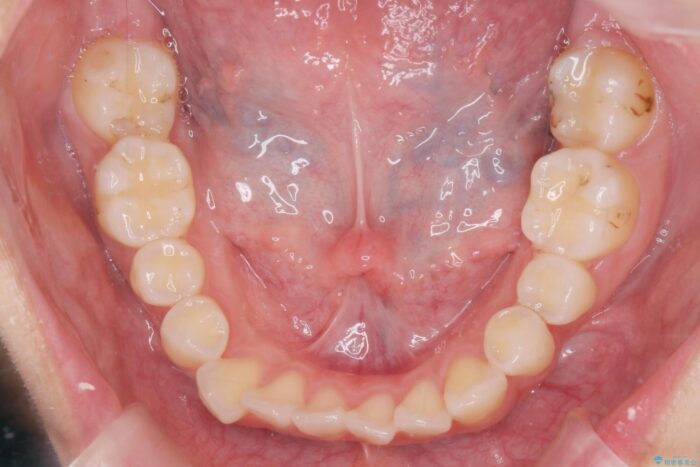 すきっ歯をワイヤー矯正で改善 治療前画像