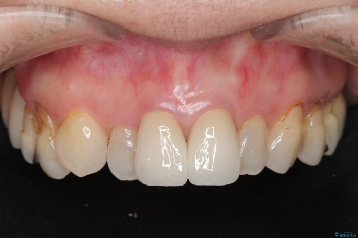 黒ずみのある前歯をセラミックで美しく 治療後画像