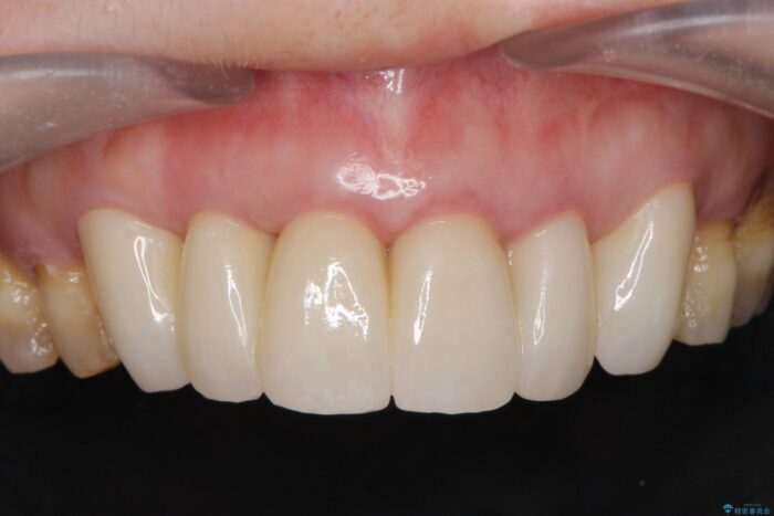 前歯のセラミックと歯周外科治療 治療後画像