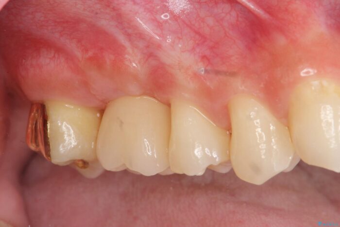 骨が足りない上あごへの骨造成を伴うインプラント治療 治療後画像