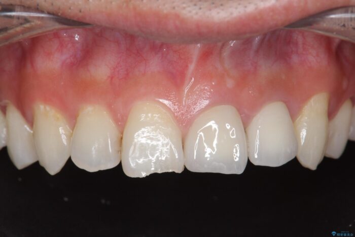 前歯のセラミック治療 治療後画像