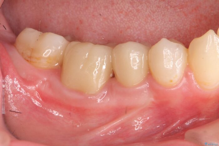 銀歯の下の虫歯治療と歯周外科治療 治療後画像