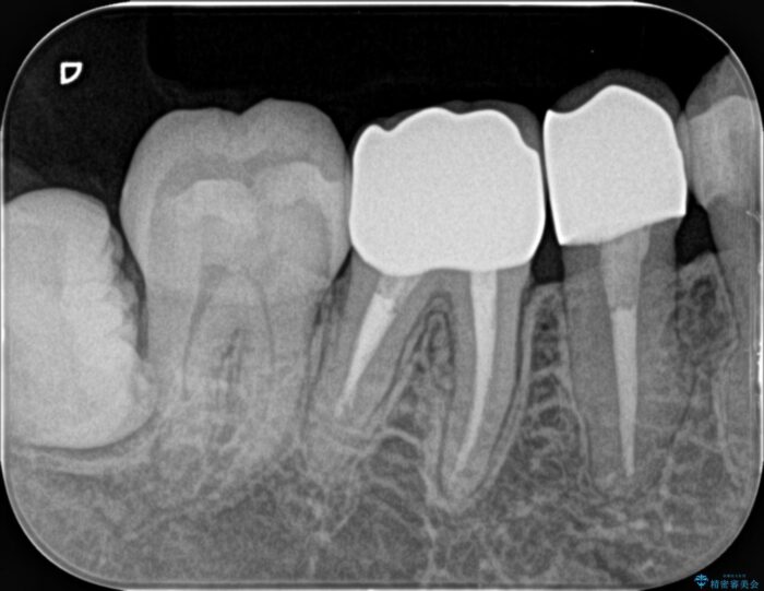 銀歯の下の虫歯治療と歯周外科治療 治療後画像