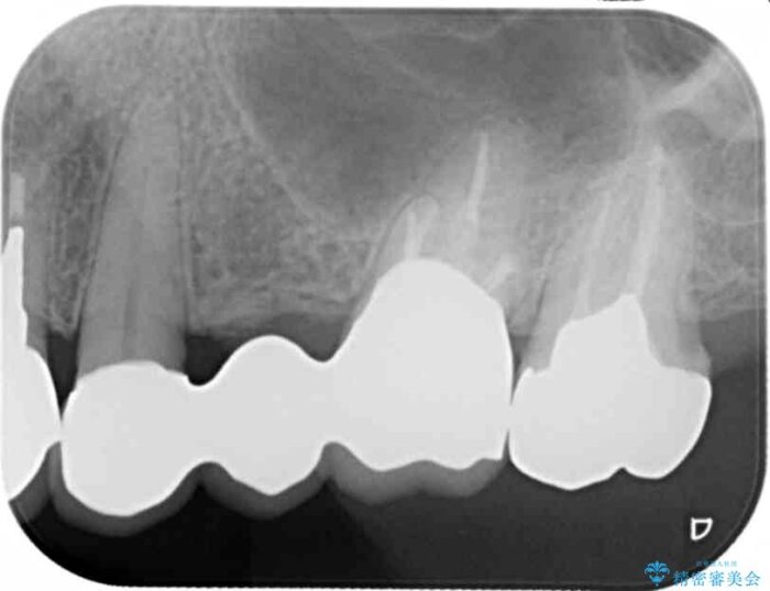 セラミックブリッジで銀歯を白く 治療後画像